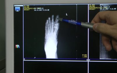 Correzione dell’alluce valgo: controllo post operatorio